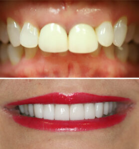 christina-greene-dentistry-before-and-after-photo12