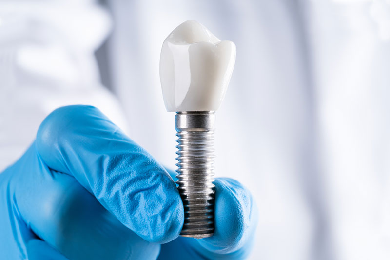 dental implant image.