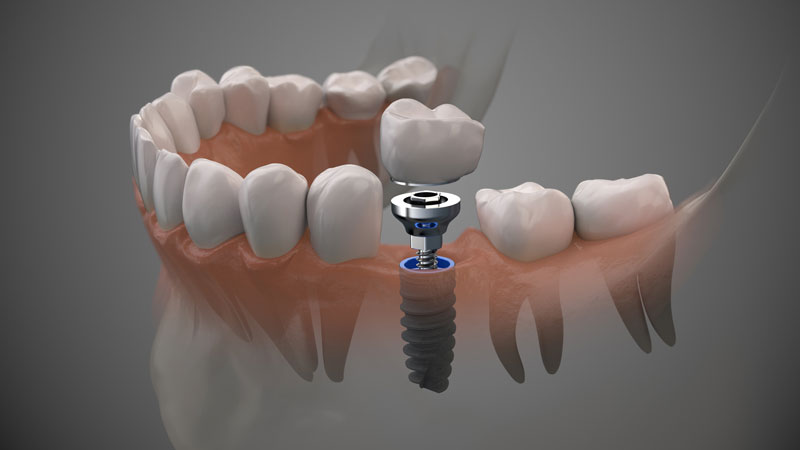 3D rendering of a human dental implant. It shows a lower jaw with a full set of teeth and a metal dental implant post that is placed into the jawbone.